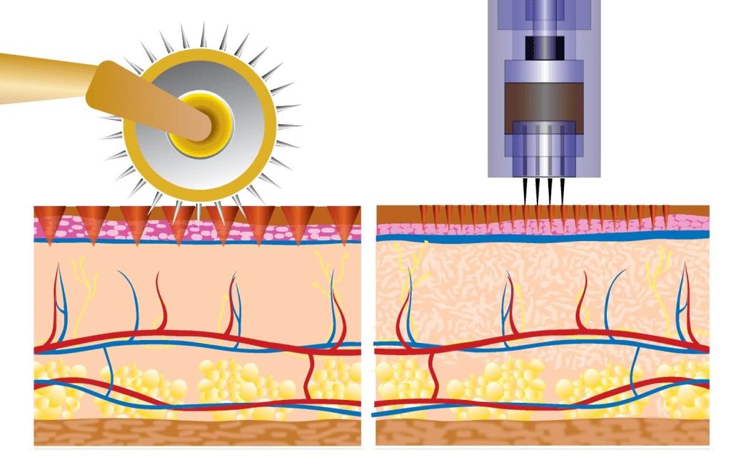 Microneedle beauty technology comparison chart
